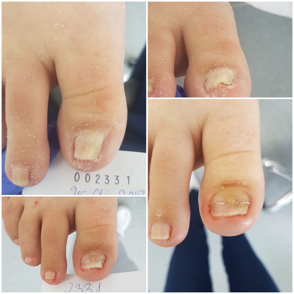 Terapia paznokcia wkręcającego 