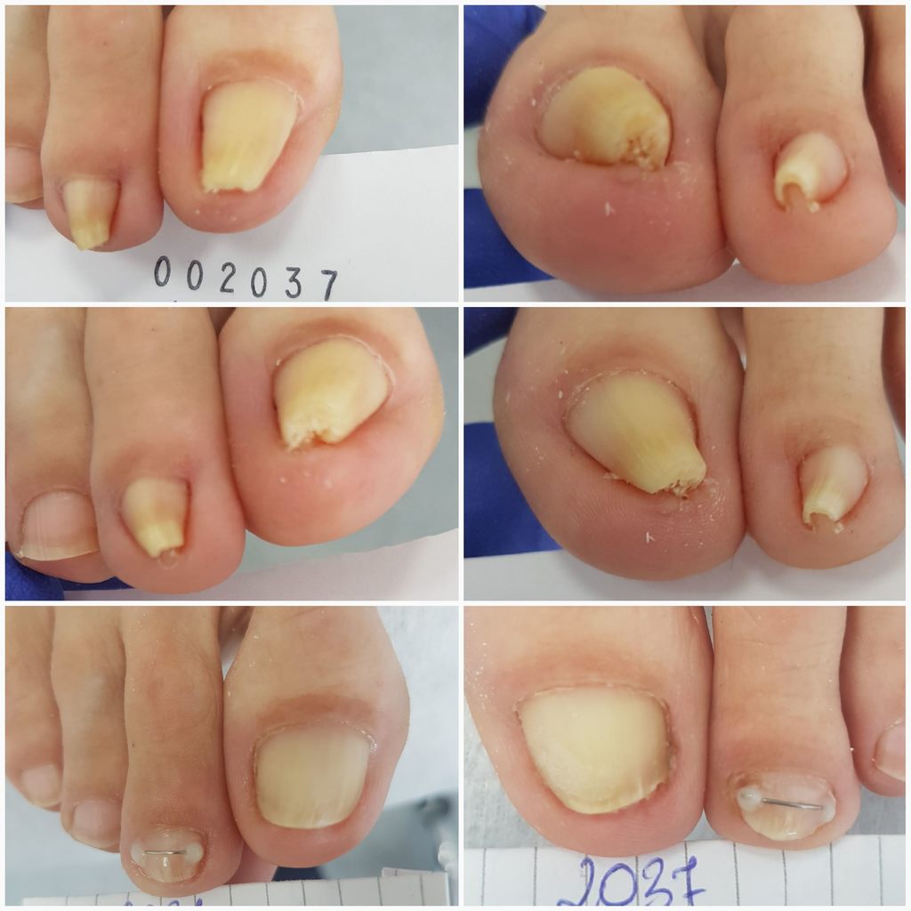 Terapia paznokcia wkręcającego 